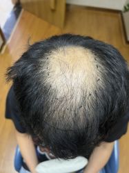 -大麦微针植发全国连锁