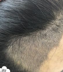 -大麦微针植发丨全国连锁