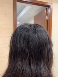 -碧莲盛·不剃发植发