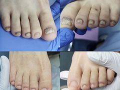 -新甲连锁灰指甲·甲沟炎·修脚(爱联店)