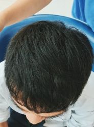 -大麦微针植发全国连锁