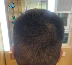 -大麦微针植发丨全国连锁