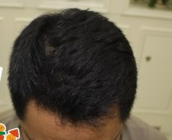 -大麦微针植发丨全国连锁