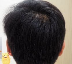 -大麦微针植发丨全国连锁