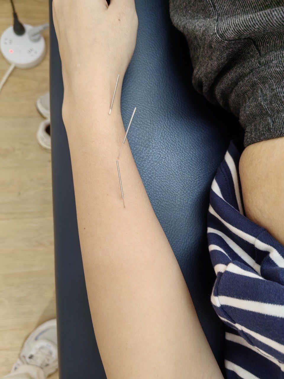 中医针灸的神奇魅力