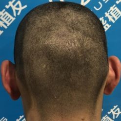 体验前-碧莲盛·不剃发植发