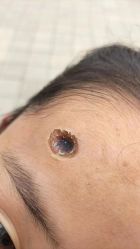 -北京美痣堂古方祛痣斑疣瘊