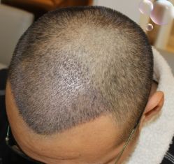 -大麦微针植发丨全国连锁