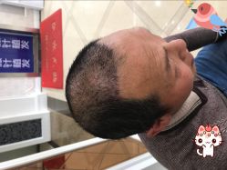 -大麦微针植发丨全国连锁