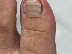 -Andrew指甲专科灰指甲·甲沟炎矫正·3D步态矫形鞋垫定制(浦三路店)