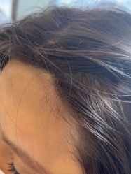 -碧莲盛·不剃发植发