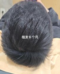 -大麦微针植发丨全国连锁