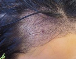 -大麦微针植发丨全国连锁