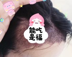 -大麦微针植发全国连锁