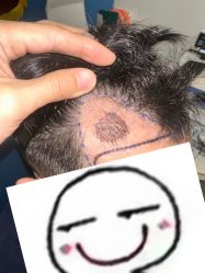 -大麦微针植发全国连锁