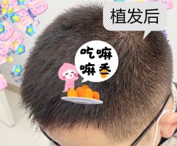 -大麦微针植发全国连锁