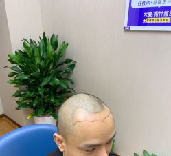-大麦微针植发全国连锁