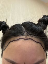 -碧莲盛·不剃发植发