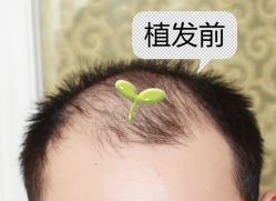 -大麦微针植发全国连锁