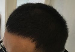-大麦微针植发全国连锁