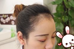 点击看大图 -大麦微针植发丨全国连锁