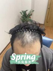 -大麦微针植发全国连锁