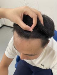 -大麦微针植发全国连锁