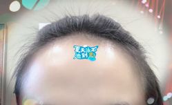 -大麦微针植发全国连锁