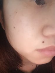 体验前-清疣美疣·痣·斑净肤中心