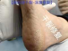-Andrew指甲专科灰指甲·甲沟炎矫正·3D步态矫形鞋垫定制(浦三路店)