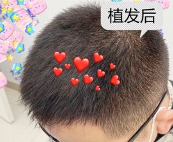 -大麦微针植发全国连锁