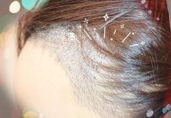 -大麦微针植发全国连锁