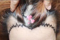 -大麦微针植发全国连锁