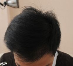 -大麦微针植发丨全国连锁