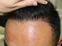 -大麦微针植发全国连锁