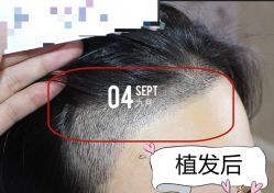 -大麦微针植发全国连锁