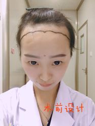 -大麦微针植发丨全国连锁