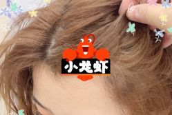 -大麦微针植发全国连锁