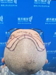 体验前-雍禾植发全国连锁