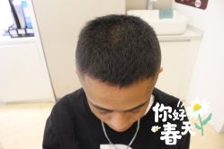 -大麦微针植发全国连锁