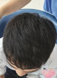 -大麦微针植发丨全国连锁