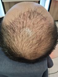 点击看大图 -大麦微针植发丨全国连锁