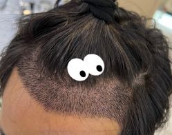 -大麦微针植发全国连锁