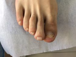 -德哥灰指甲脚气甲沟炎跖疣护理