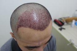 点击看大图 -大麦微针植发丨全国连锁