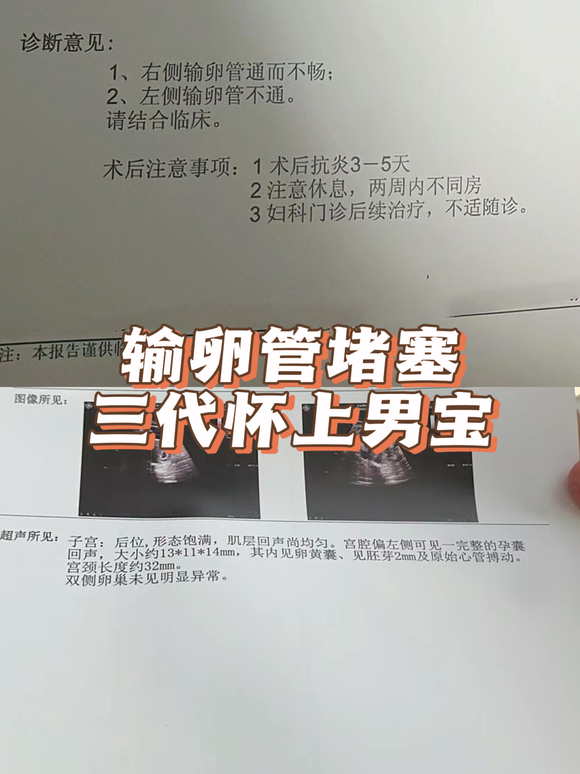 输卵管堵塞需要做试管婴儿吗?