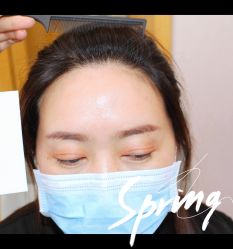 体验后-大麦微针植发全国连锁