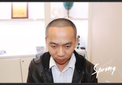 点击看大图 体验后-大麦微针植发全国连锁