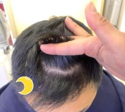 -大麦微针植发丨全国连锁