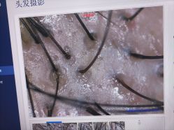 体验前-大麦微针植发丨全国连锁